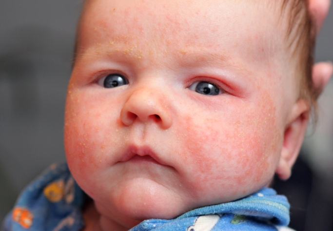 Τι είναι η ατοπική δερματίτιδα (έκζεμα) στα μωρά και που οφείλεται